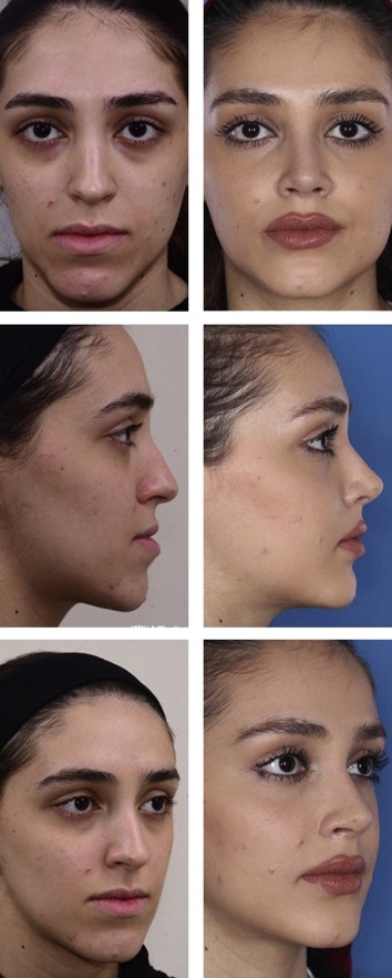 closed rhinoplasty procedure closed rhinoplasty procedure