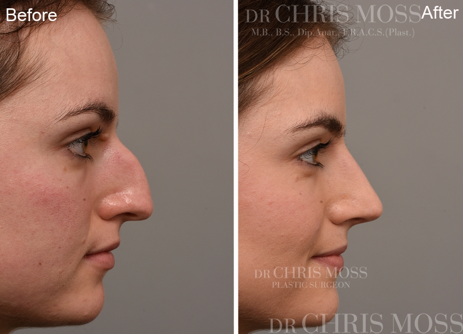 closed rhinoplasty procedure closed rhinoplasty procedure