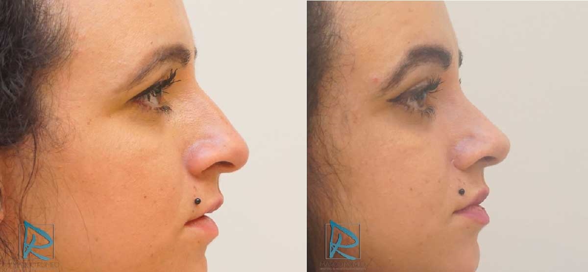closed rhinoplasty procedure closed rhinoplasty procedure